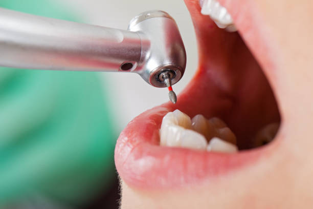 Best Urgent Care for Lost Fillings or Crowns in Sandston, VA